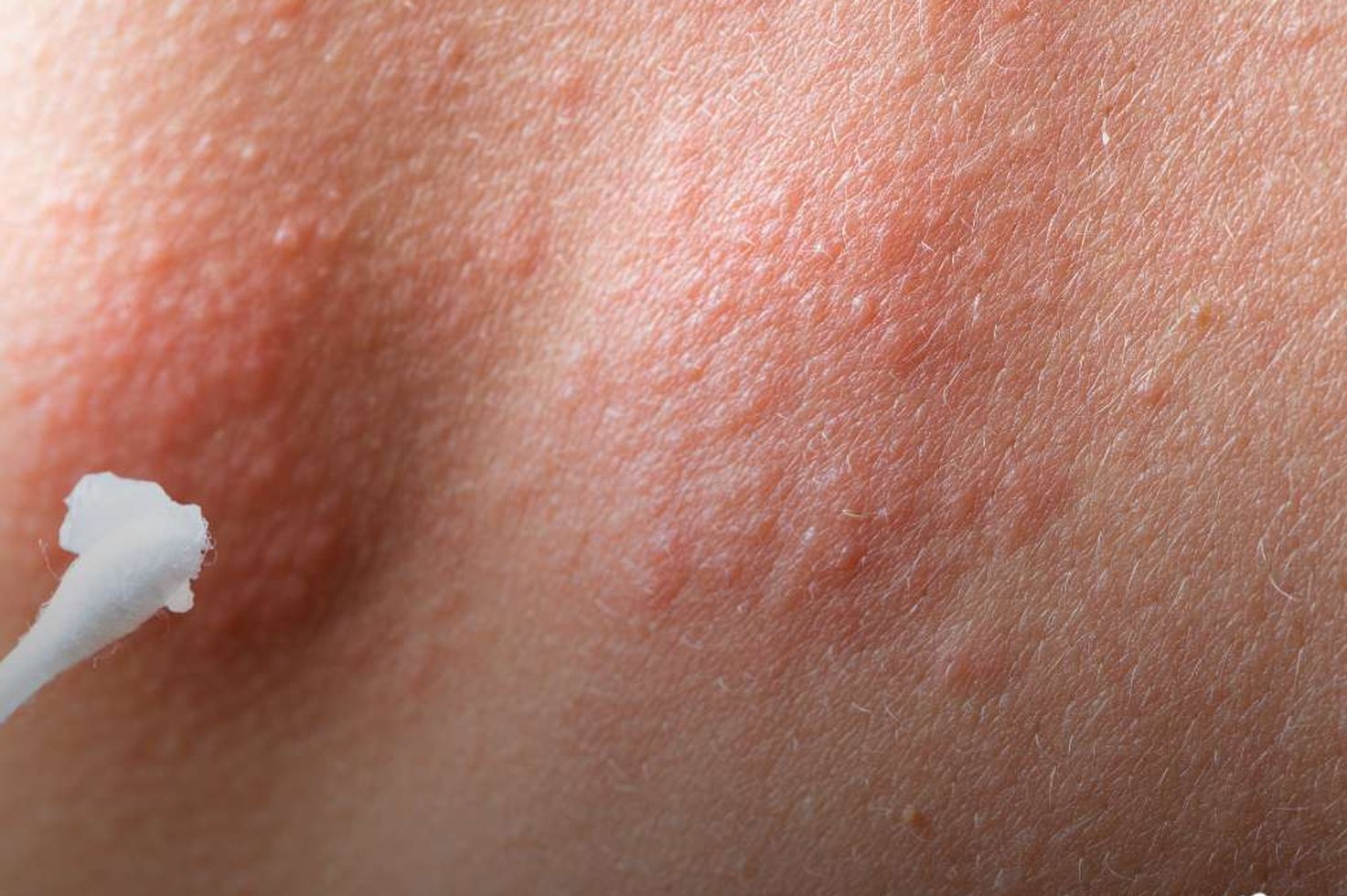 What are the of causes hives? | What are the symptoms of hives? | How long do hives last? | When to seek medical treatment for hives? | How are the hives treated and cured? | Various pictures of hives | diseases that cause hives in adults male and female | what are the Causes of hives in female adults | Can hives be a sign of something serious diseases |Various treatment of hives | How to cure hives fast and quick | Pictures of hives rash on legs and hand